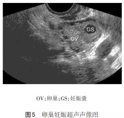 最新型流產(chǎn)技術，改變未來的希望之光，最新型流產(chǎn)技術，點亮未來之光