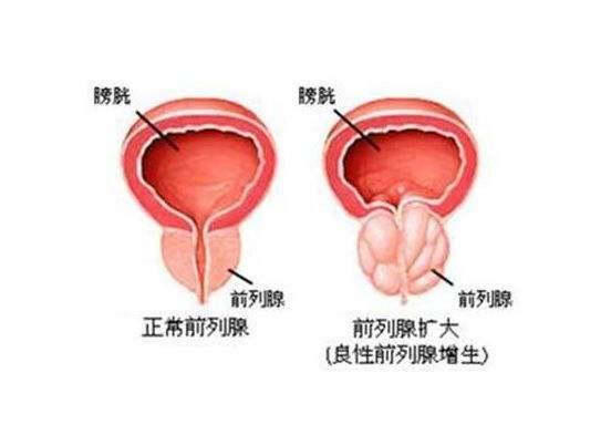 前列腺是怎么回事？需要治療嗎？一篇文章解答您的疑惑，前列腺詳解，癥狀、原因與治療方法，解答您的疑惑